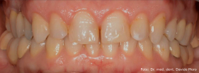 Abrasioni dentarie: Il paziente richiede un trattamento estetico con faccette
ceramiche