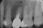 RX infezione della radice di dente non recuperabile